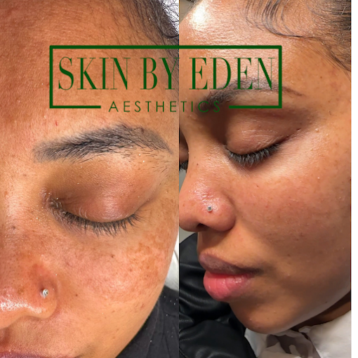 Original client before and after photographs of a pigmentation journey, before on the left and after on the right