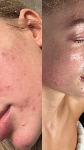 Original client before and after photographs of an acne and congestion journey, before on the left and after on the right