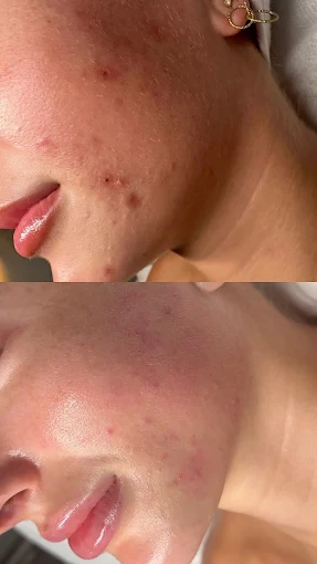 Original client before and after photographs of an acne and congestion journey, before above and after below