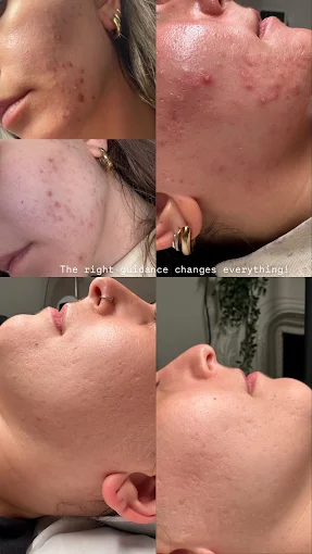 Original client before and after photographs of an acne journey, shown as a collage of moments across the treatment plan